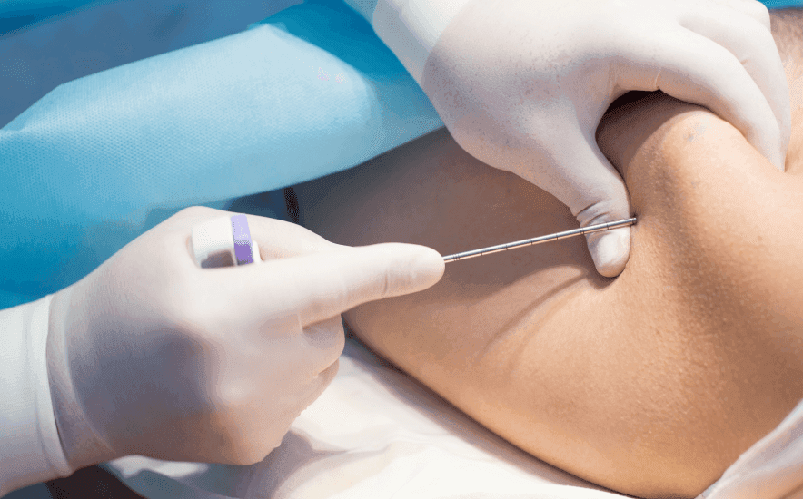 Bone Marrow Aspirate (BMA) Therapy